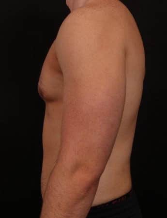 After Image: Male Gynecomastia and Liposuction - left-side