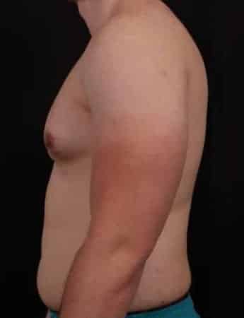 Before Image: Male Gynecomastia and Liposuction - left-side