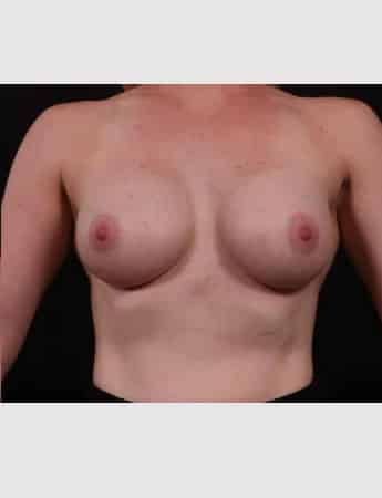 After Image: Breast Augmentation - front