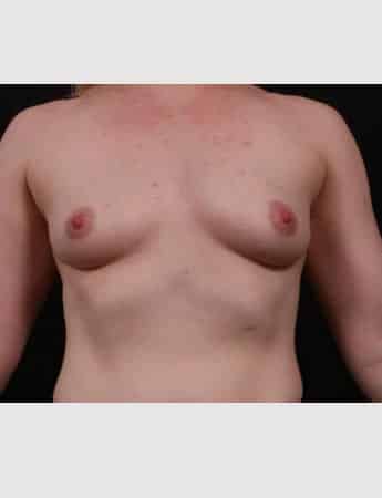 Before Image: Breast Augmentation - front