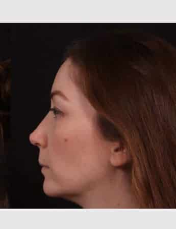 After Image: Rhinoplasty & Buccal Fat Removal - left-side