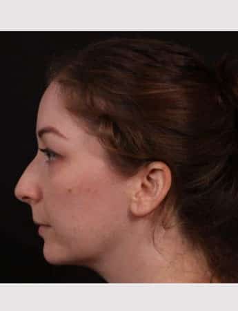 Before Image: Rhinoplasty & Buccal Fat Removal - left-side