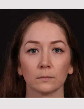 After Image: Rhinoplasty & Buccal Fat Removal - front