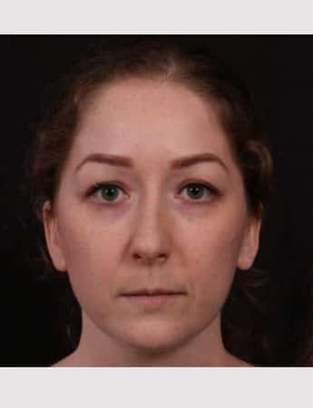 Before Image: Rhinoplasty & Buccal Fat Removal - front