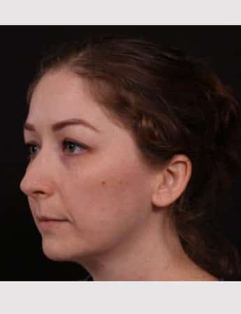 Before Image: Rhinoplasty & Buccal Fat Removal - left-front-oblique