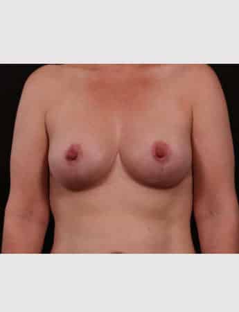 Mastopexy (Breast Lift) with Auto Augmentation