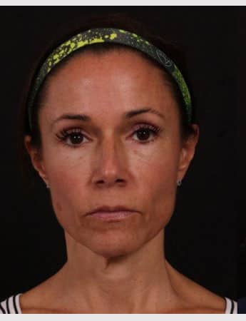 Before Image: Full Facelift - front