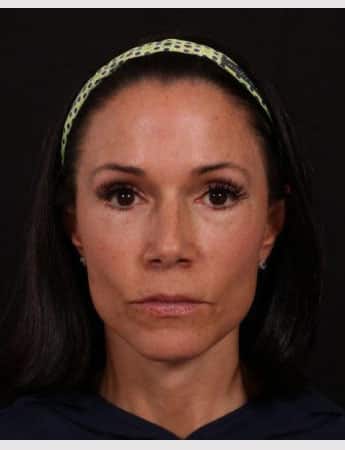 After Image: Full Facelift - front