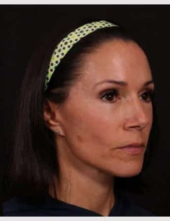 After Image: Full Facelift - right-front-oblique