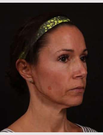 Before Image: Full Facelift - right-front-oblique
