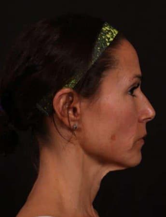Before Image: Full Facelift - right-side
