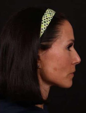 After Image: Full Facelift - right-side