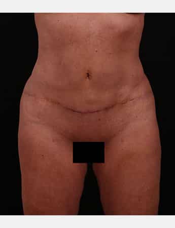 After Image: Tummy Tuck (Abdominoplasty) - front
