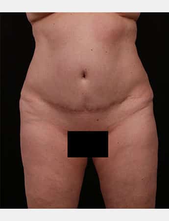 Before Image: Tummy Tuck (Abdominoplasty) - front