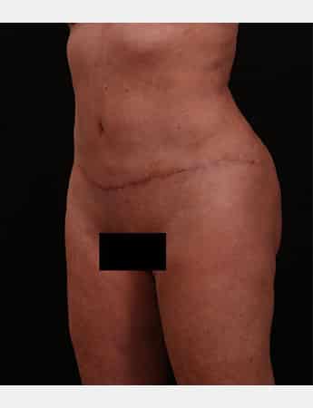 After Image: Tummy Tuck (Abdominoplasty) - left-front-oblique