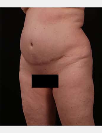 Before Image: Tummy Tuck (Abdominoplasty) - left-front-oblique