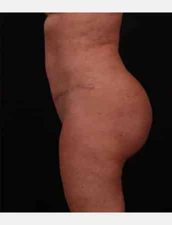 After Image: Tummy Tuck (Abdominoplasty) - left-side