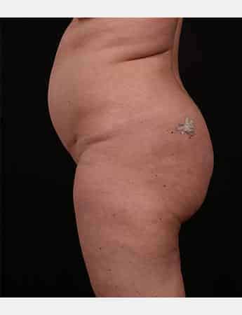 Before Image: Tummy Tuck (Abdominoplasty) - left-side