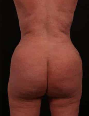 After Image: Tummy Tuck (Abdominoplasty) - back