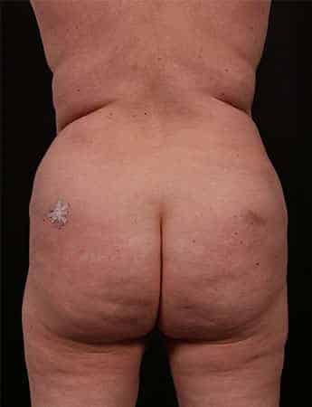 Before Image: Tummy Tuck (Abdominoplasty) - back