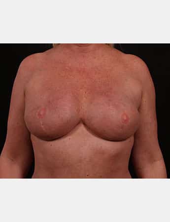 After Image: Secondary Breast Surgery - front