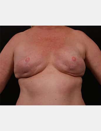 Before Image: Secondary Breast Surgery - front