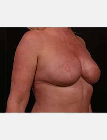 After Image: Secondary Breast Surgery - right-front-oblique