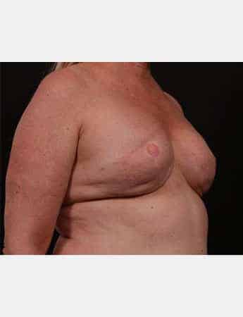 Before Image: Secondary Breast Surgery - right-front-oblique