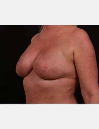 After Image: Secondary Breast Surgery - left-front-oblique