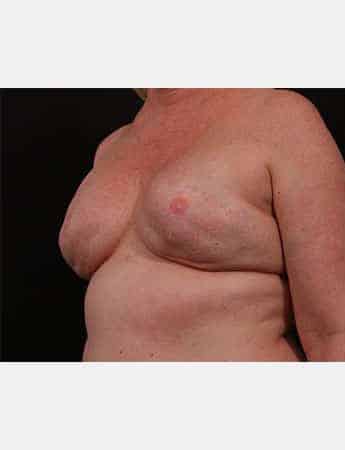 Before Image: Secondary Breast Surgery - left-front-oblique