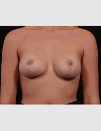After Image: Breast Reduction - front