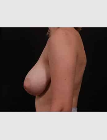 Before Image: Breast Reduction - left-side