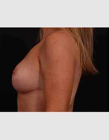 After Image: Mastopexy (Breast Lift) with Auto Augementation and Fat Grafting - left-side