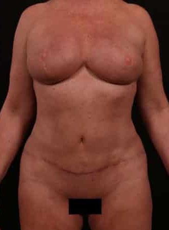 After Image: Mommy Makeover - front