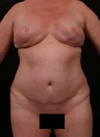 Before Image: Mommy Makeover - front