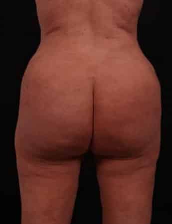 Butt Lift with Fat Grafting