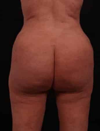 After Image: Butt Lift with Fat Grafting - back