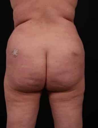 Before Image: Butt Lift with Fat Grafting - back