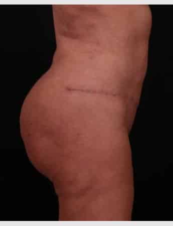 After Image: Butt Lift with Fat Grafting - right-side