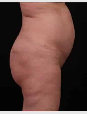 Before Image: Butt Lift with Fat Grafting - right-side