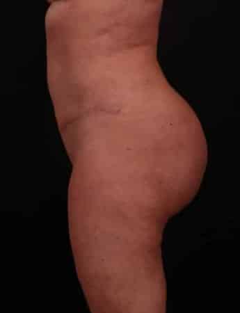 After Image: Butt Lift with Fat Grafting - left-side