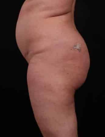 Before Image: Butt Lift with Fat Grafting - left-side