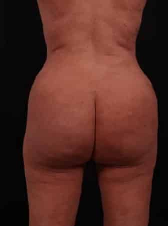 After Image: Liposuction - back