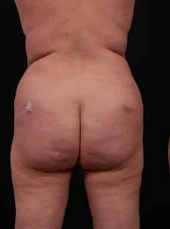Before Image: Liposuction - back