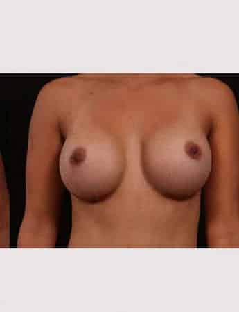 After Image: Breast Augmentation - front