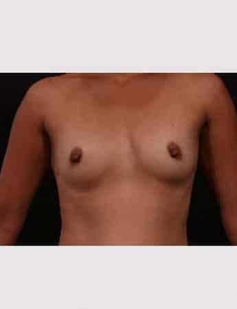 Before Image: Breast Augmentation - front