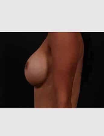 After Image: Breast Augmentation - left-side