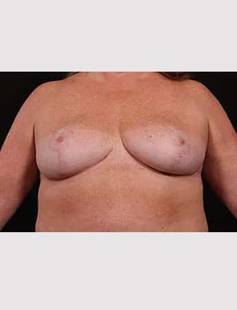 After Image: Outer Chest Skin Excision - front