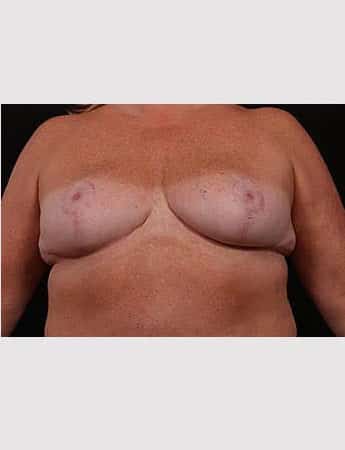 Outer Chest Skin Excision