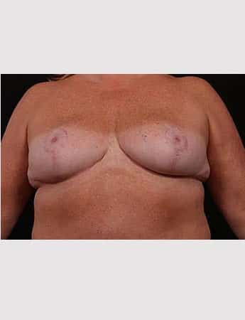 Before Image: Outer Chest Skin Excision - front
